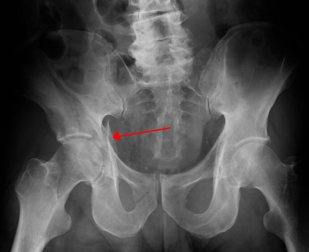 Fractura acetabular, pelvis AP