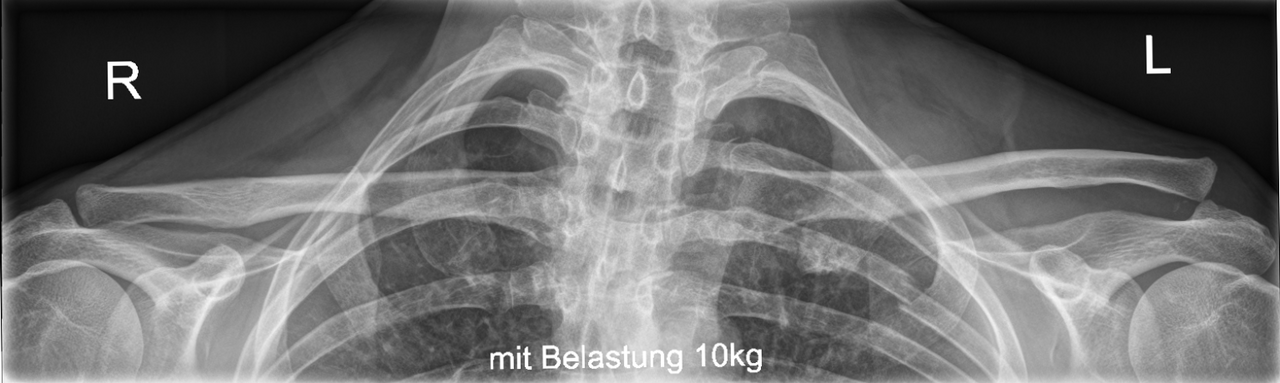 Lussazione acromioclavicolare (Tossy III / Rockwood III), proiezione sotto carico