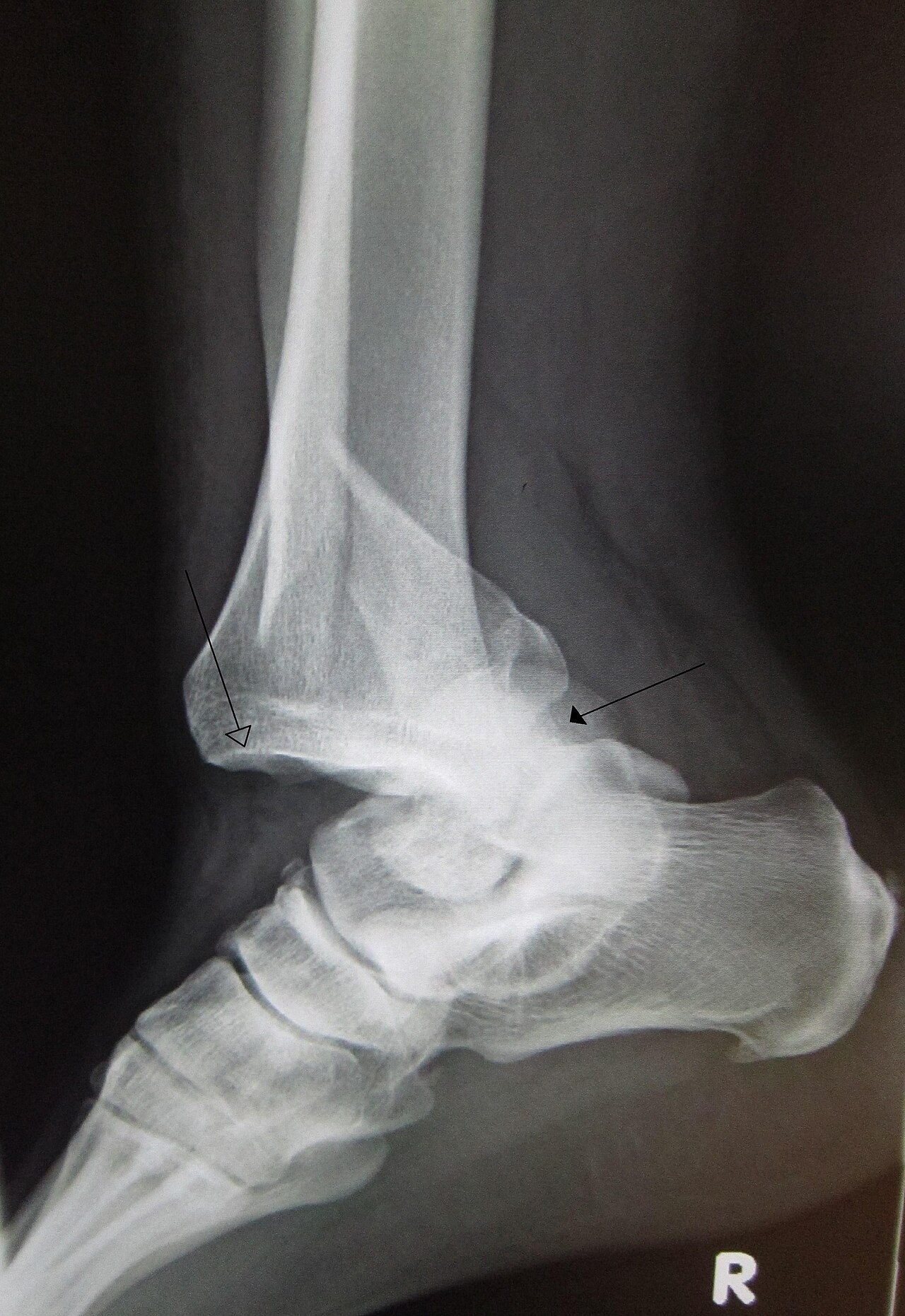 Ankle fracture-dislocation, lateral