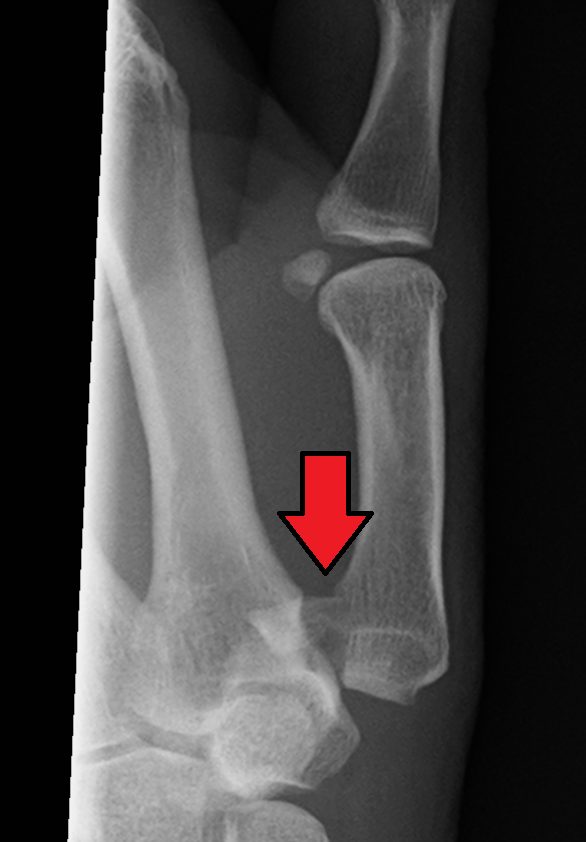 Fractura de Bennett (flecha)