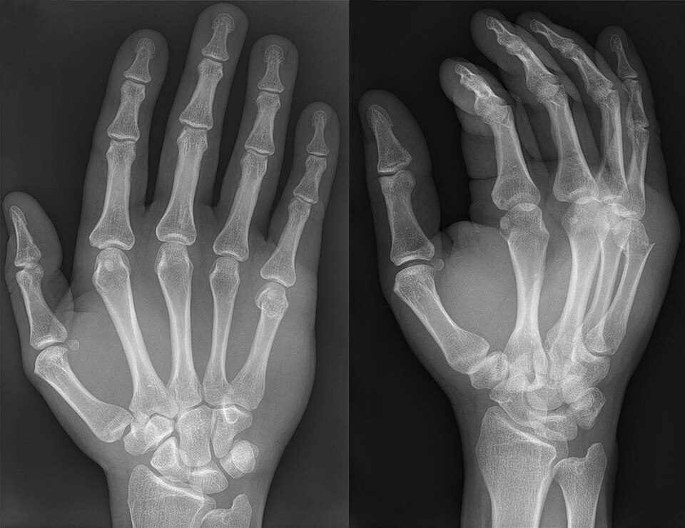 Boxer's fracture of the 5th metacarpal, PA and oblique