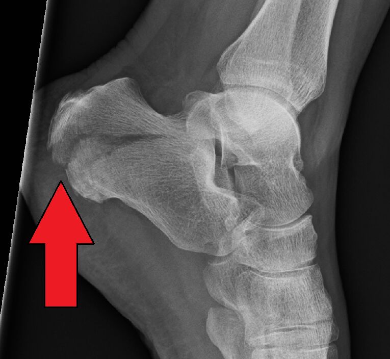 Calcaneus fracture, lateral view