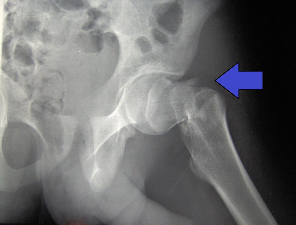 Trochanteric hip fracture, AP