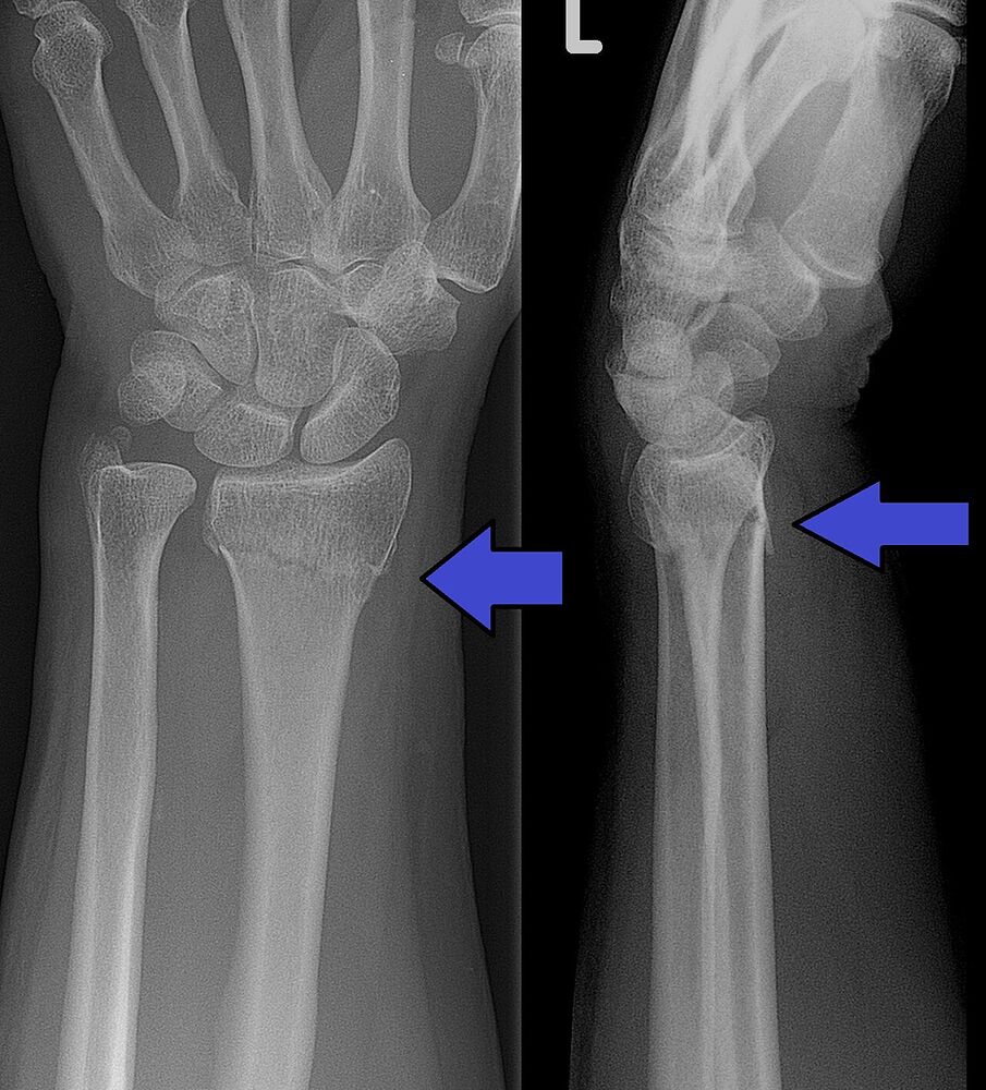 Fractura de Colles, PA y lateral