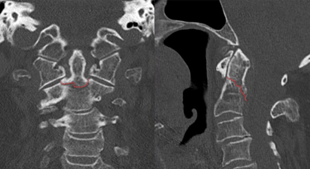 Fractura de odontoides tipo II, TC coronal y sagital