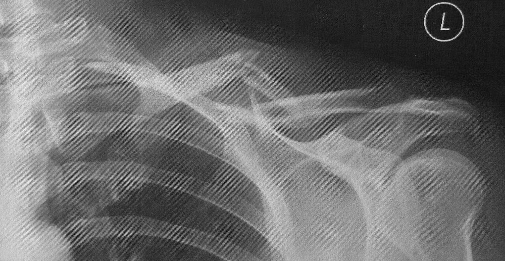 Displaced midshaft clavicle fracture