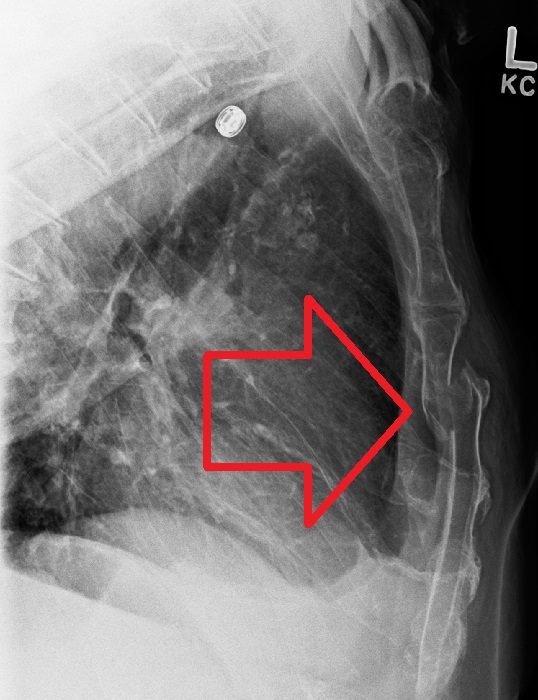 Displaced sternal fracture, lateral view