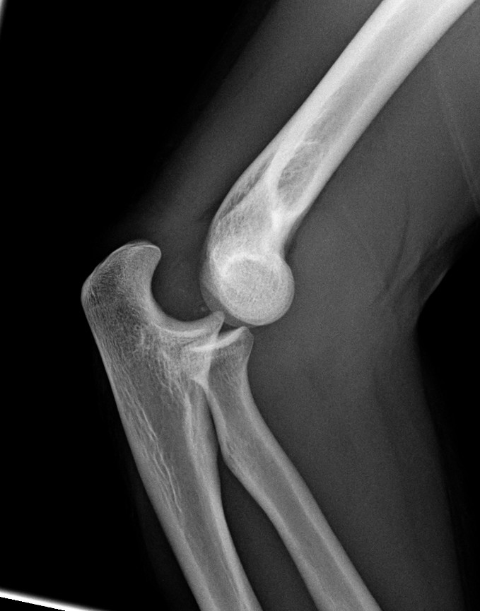 Luxación posterior de codo, lateral