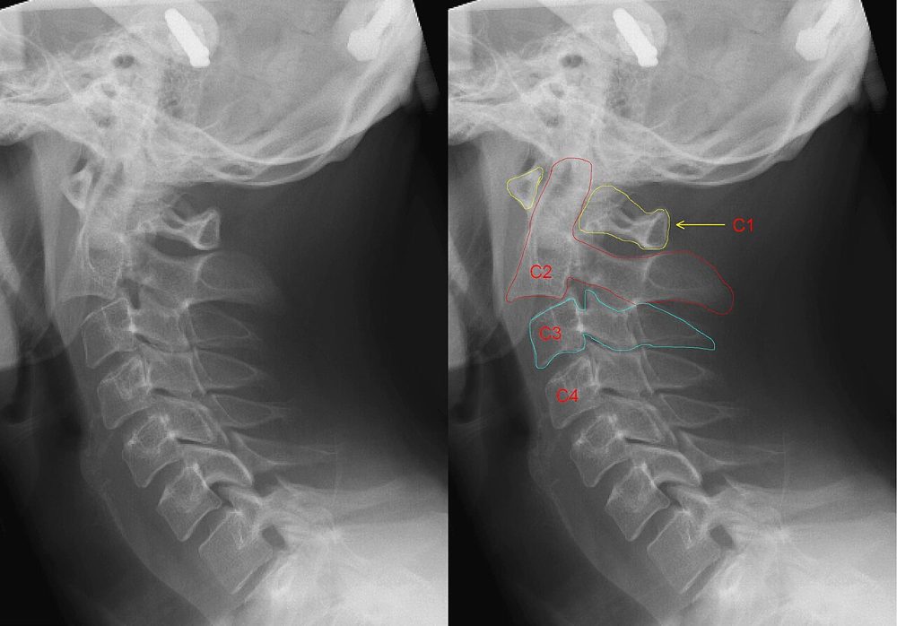 Fracture du pendu, rachis cervical de profil