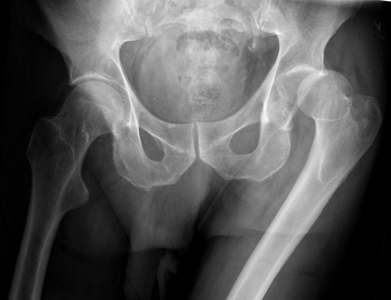 Posterior hip dislocation, AP pelvis