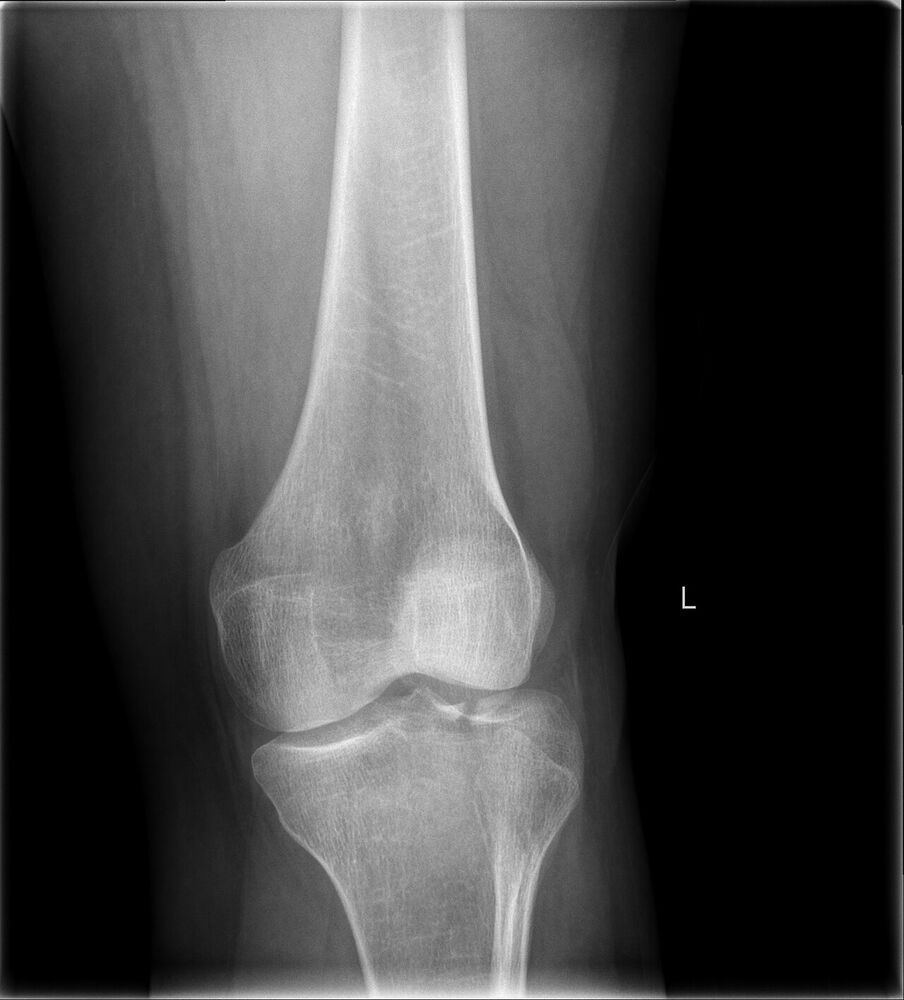 Fractura de la meseta tibial lateral, rodilla AP