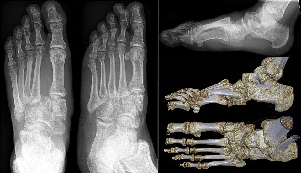 Frattura-lussazione di Lisfranc (parziale, laterale), radiografia e TC 3D