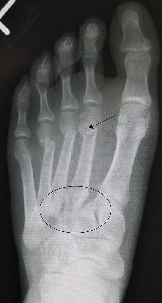 Lisfranc injury with distal metatarsal fractures, AP foot