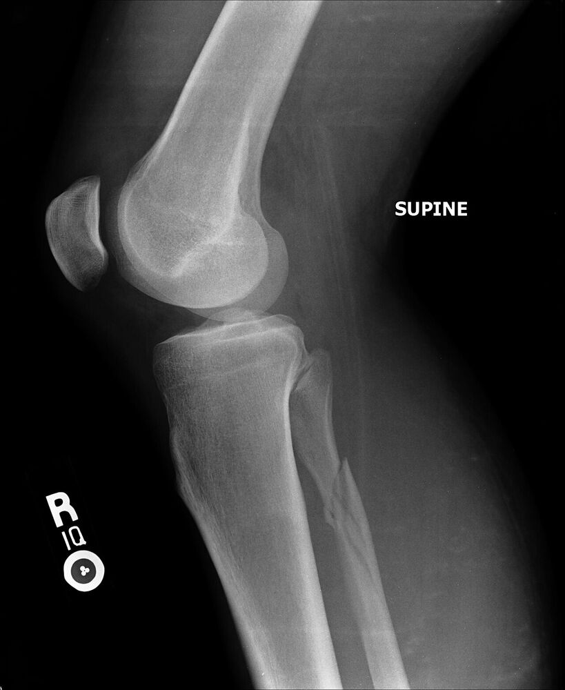 Lesión de Maisonneuve: fractura del peroné proximal