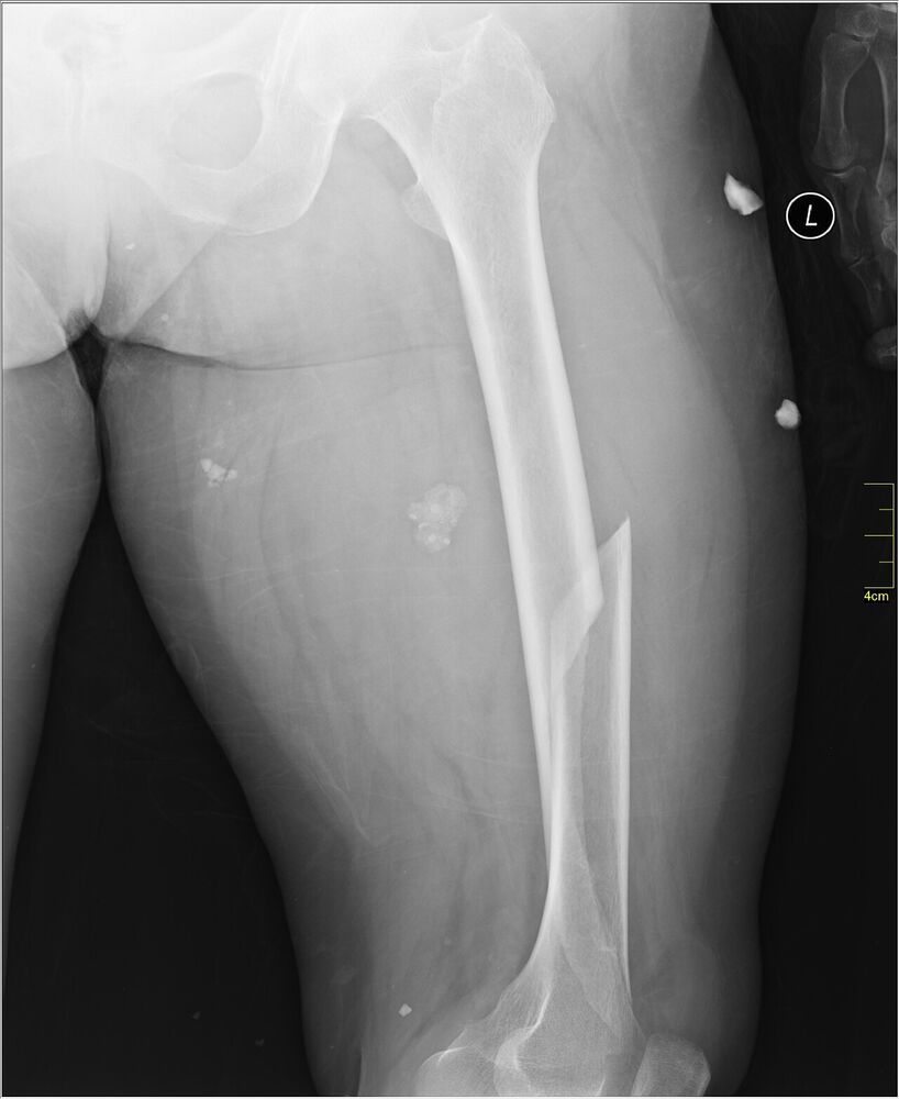 Femoral shaft fracture