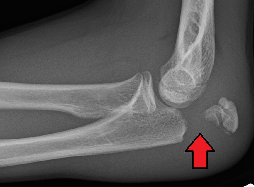 Olecranon fracture, lateral elbow
