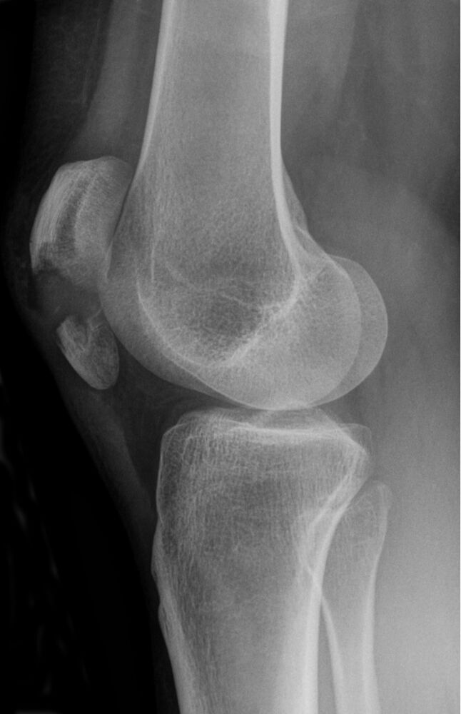 Transverse patella fracture, lateral knee