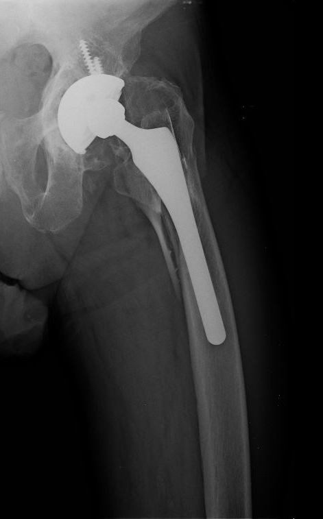 Periprosthetic femoral fracture around an uncemented hip stem