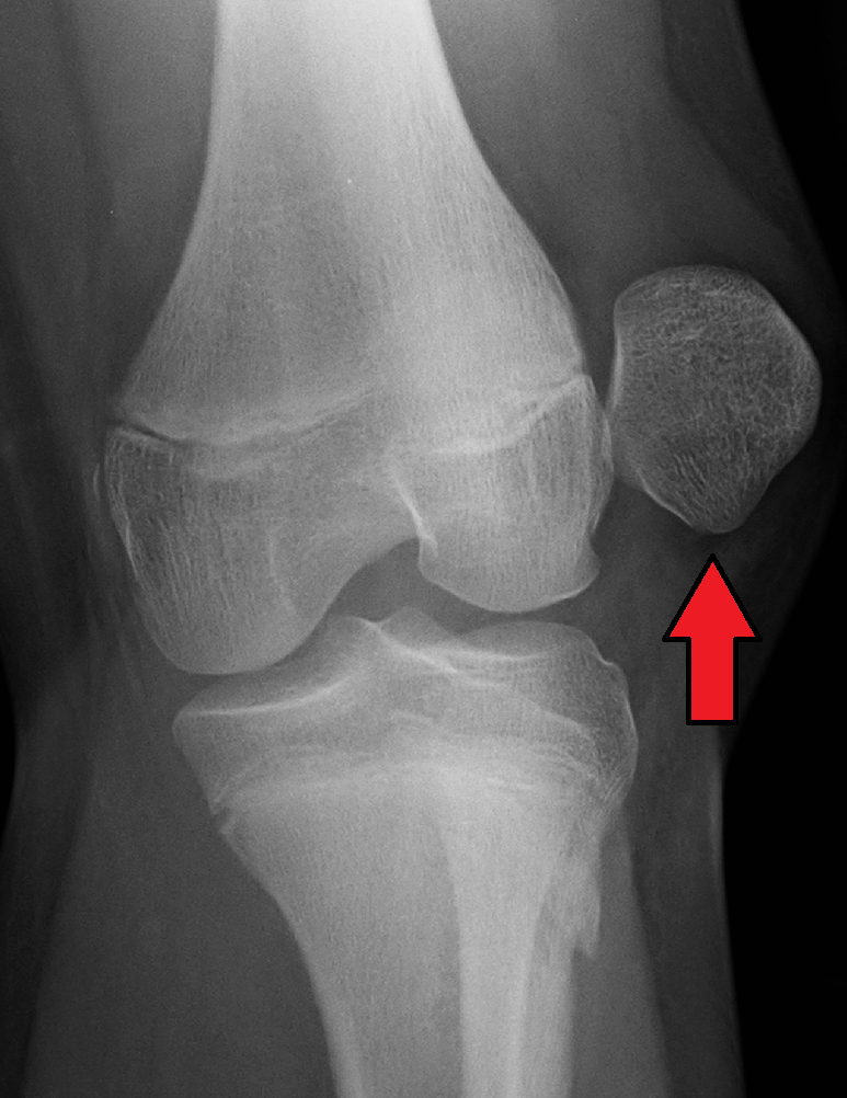 Lateral patellar dislocation, AP knee