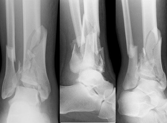 Tibial pilon fracture