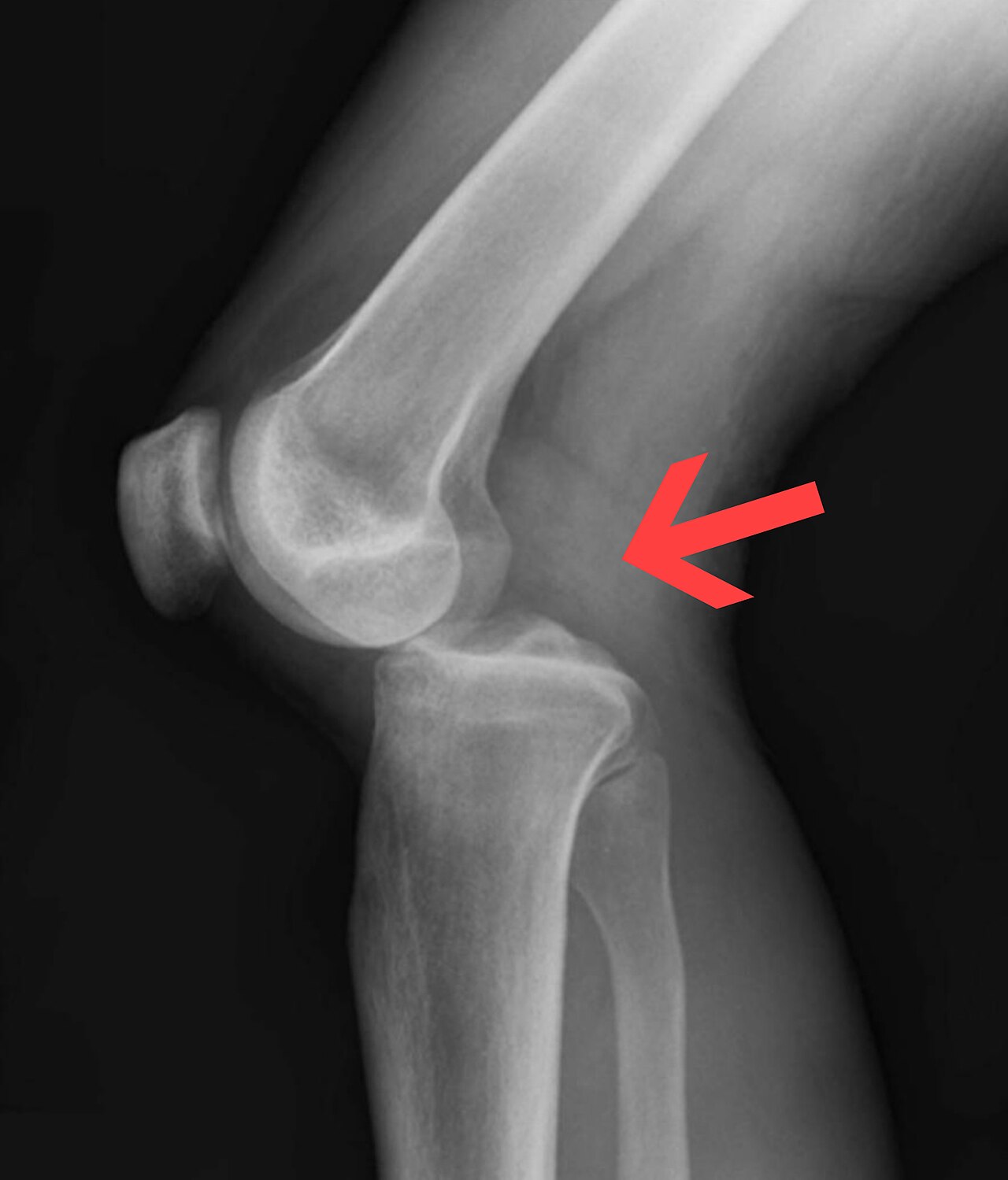 Posterior knee dislocation, lateral