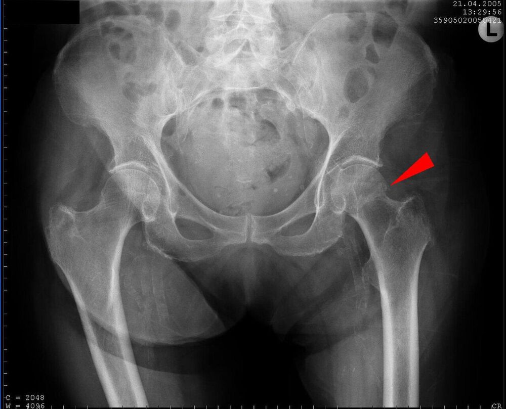Fracture non déplacée du col fémoral, bassin de face