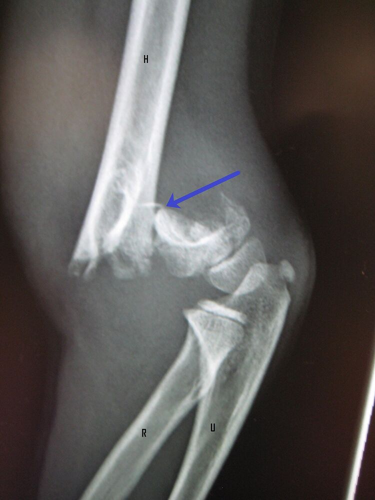 Suprakondyläre Humerusfraktur beim Kind