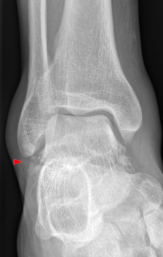 Lateral process fracture of the talus, AP ankle