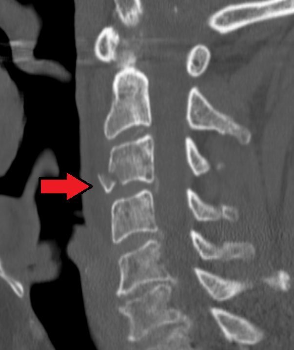 Teardrop fracture of C3, sagittal CT