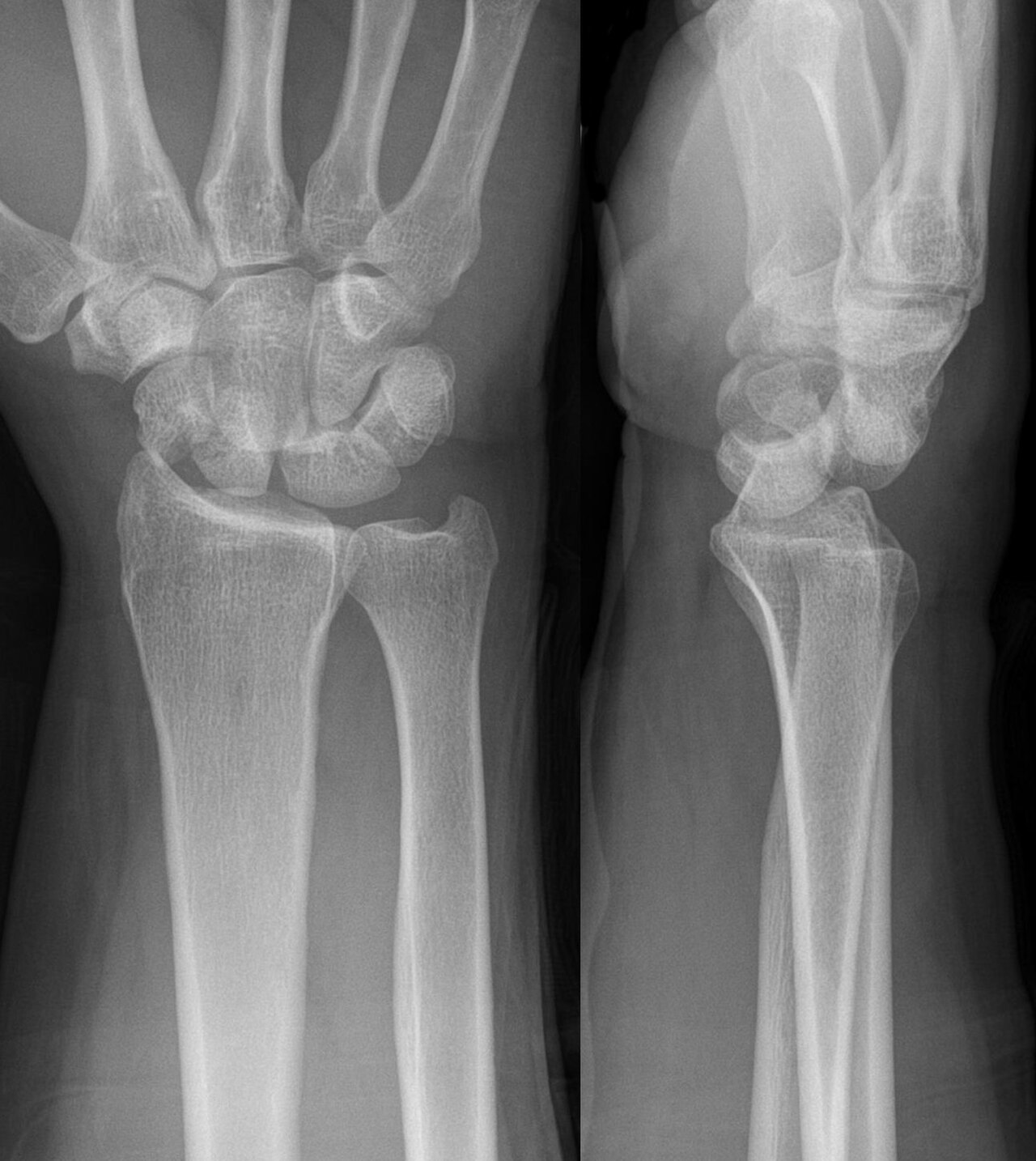 Fractura-luxación perilunar transescafoidea, PA y lateral