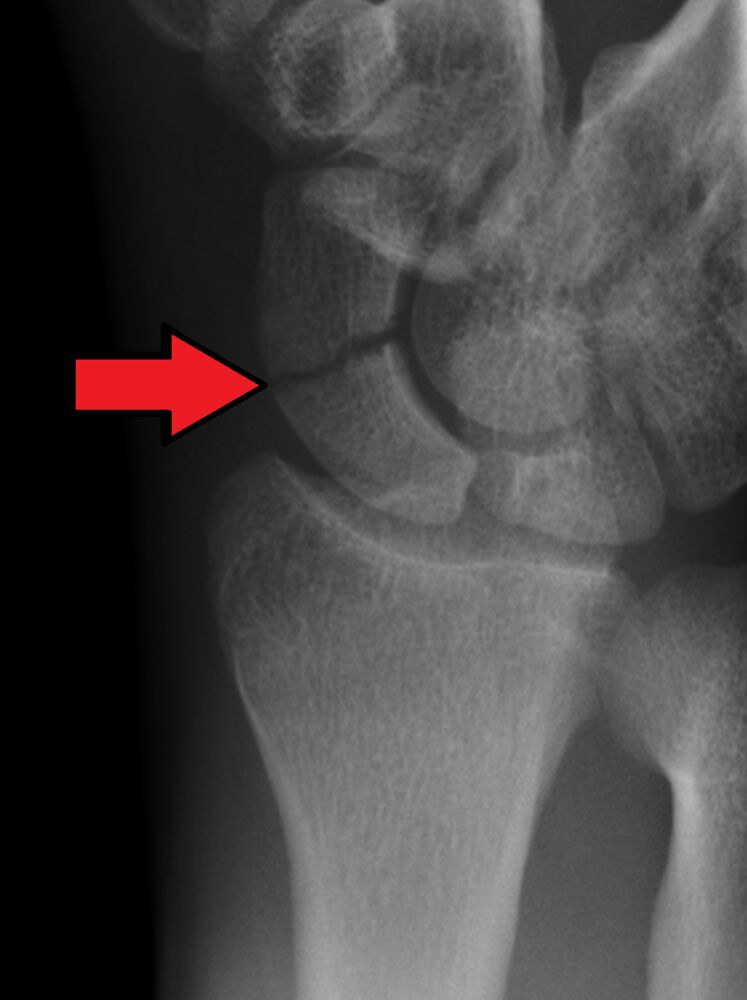 Scaphoid waist fracture
