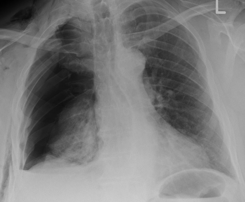 Right rib fractures with pneumothorax, chest X-ray